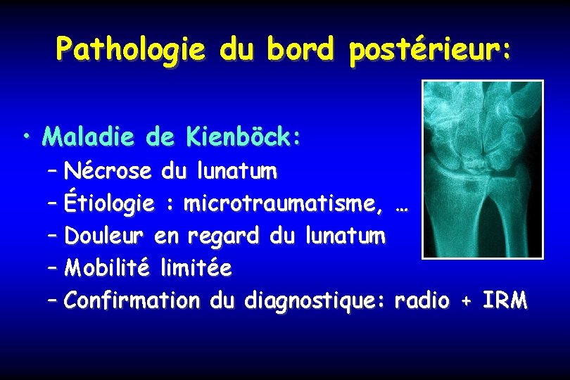 Pathologie du bord postérieur: • Maladie de Kienböck: – Nécrose du lunatum – Étiologie