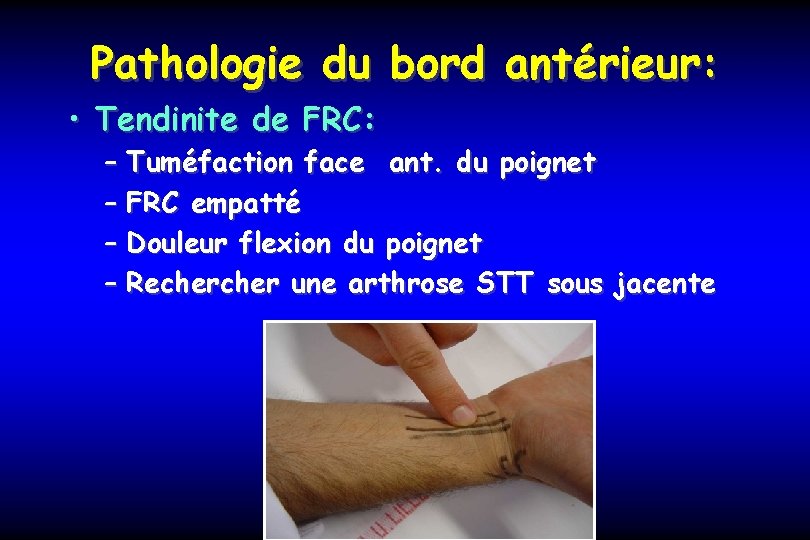 Pathologie du bord antérieur: • Tendinite de FRC: – Tuméfaction face ant. du poignet
