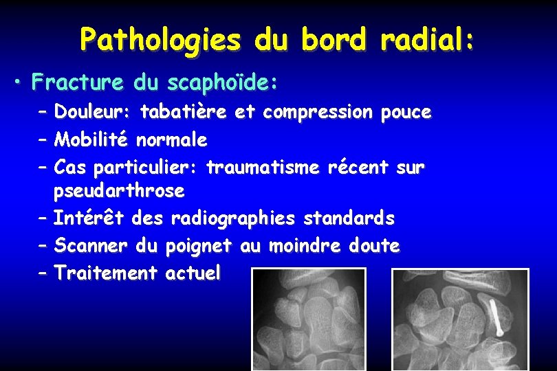 Pathologies du bord radial: • Fracture du scaphoïde: – Douleur: tabatière et compression pouce