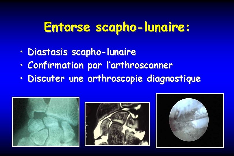 Entorse scapho-lunaire: • Diastasis scapho-lunaire • Confirmation par l’arthroscanner • Discuter une arthroscopie diagnostique
