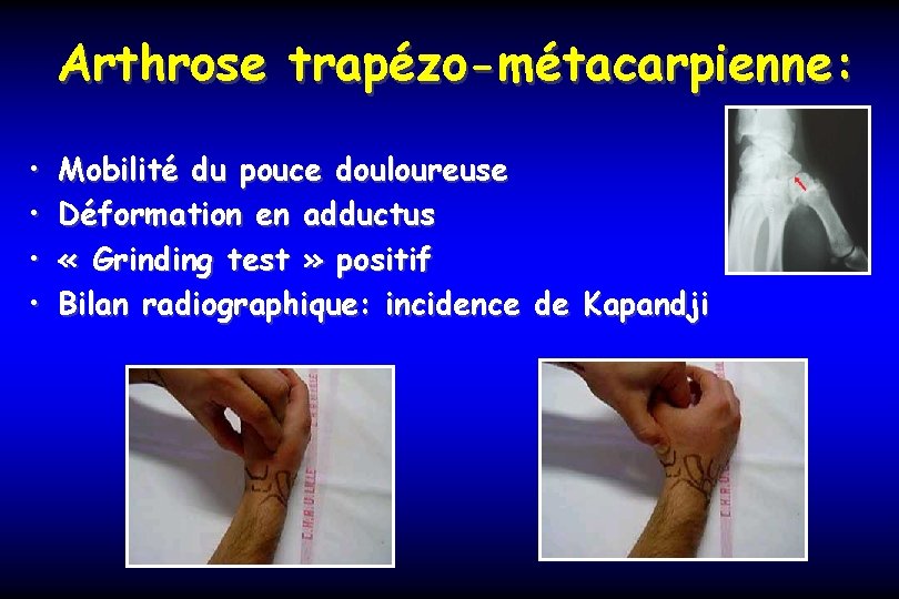 Arthrose trapézo-métacarpienne: • • Mobilité du pouce douloureuse Déformation en adductus « Grinding test