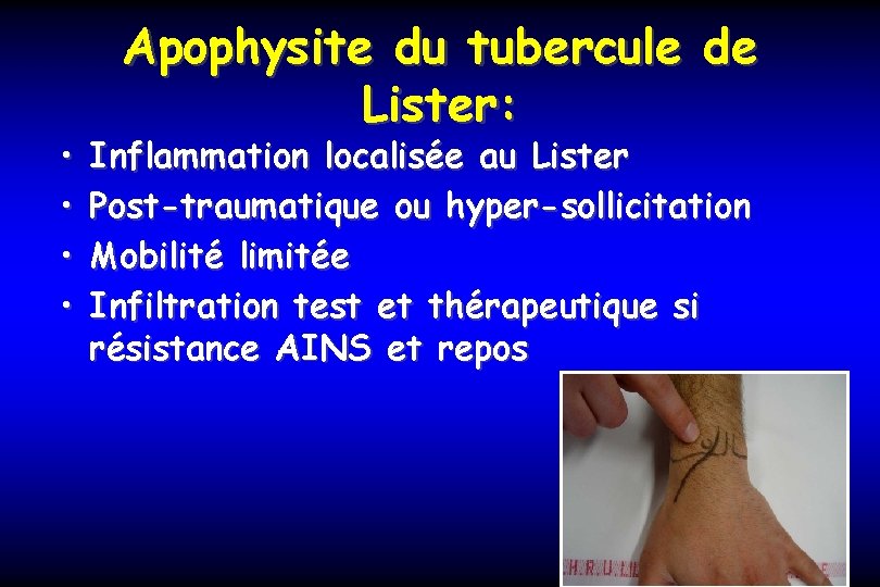  • • Apophysite du tubercule de Lister: Inflammation localisée au Lister Post-traumatique ou