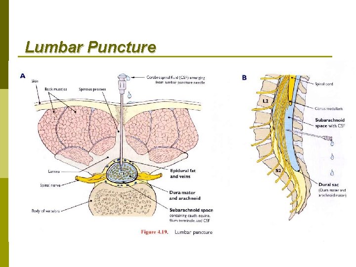 Lumbar Puncture 