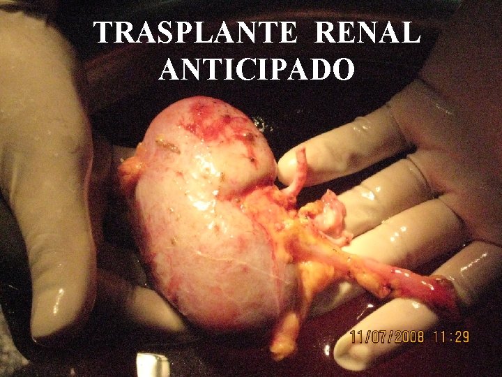 TRASPLANTE RENAL ANTICIPADO 