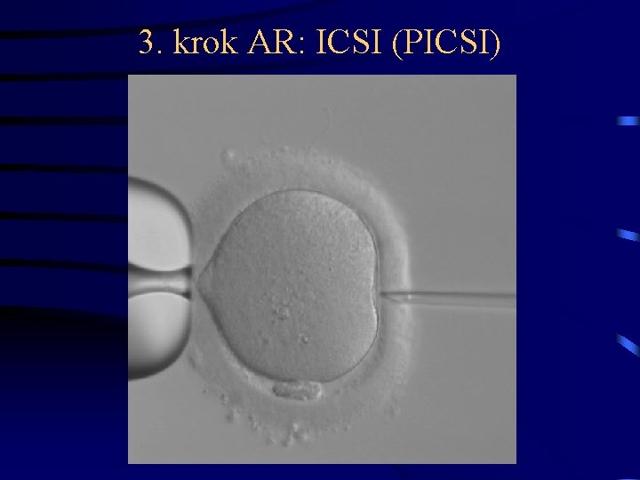3. krok AR: ICSI (PICSI) 