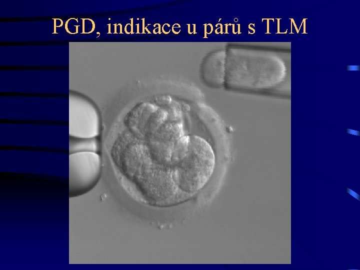 PGD, indikace u párů s TLM 