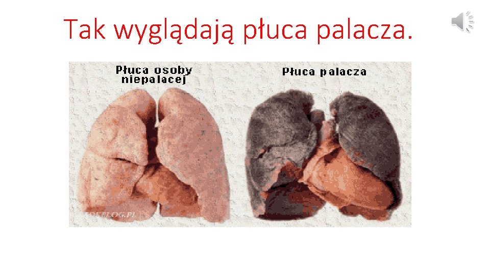 Tak wyglądają płuca palacza. 