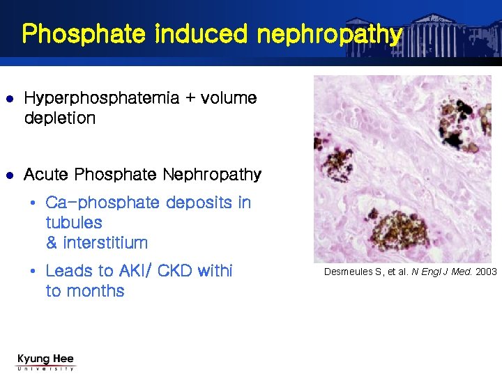 Phosphate induced nephropathy l Hyperphosphatemia + volume depletion l Acute Phosphate Nephropathy • Ca-phosphate