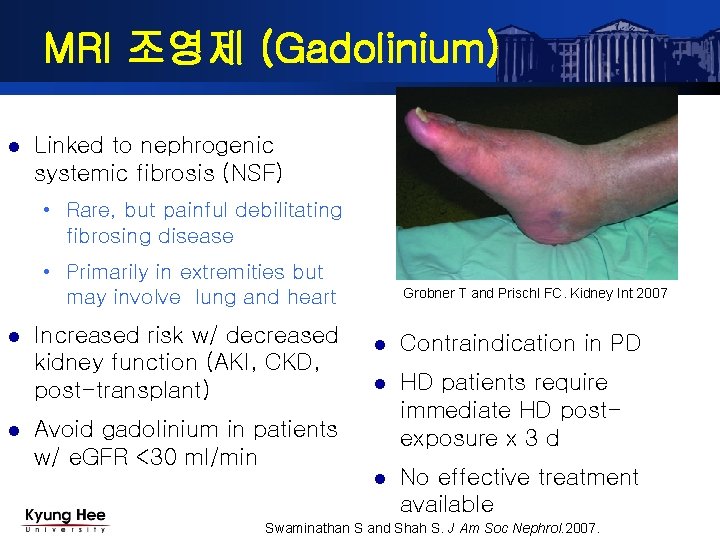 MRI 조영제 (Gadolinium) l Linked to nephrogenic systemic fibrosis (NSF) • Rare, but painful MRI 조영제 (Gadolinium) l Linked to nephrogenic systemic fibrosis (NSF) • Rare, but painful