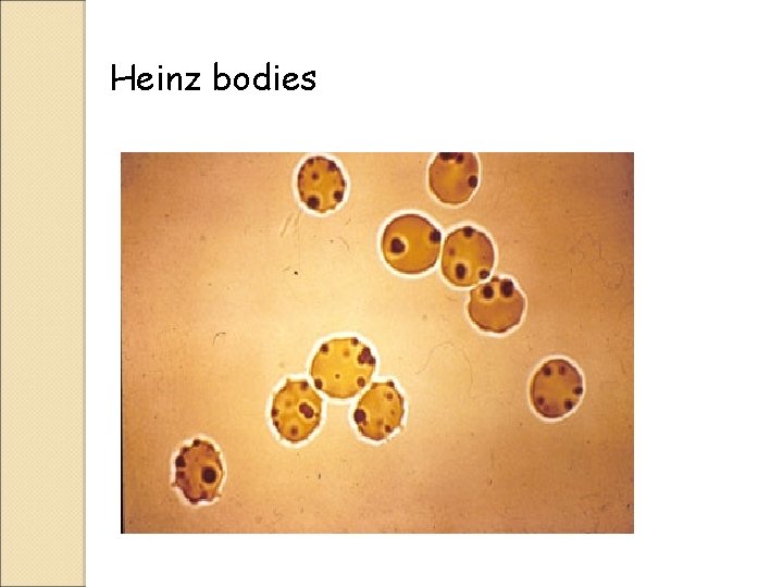 Heinz bodies 