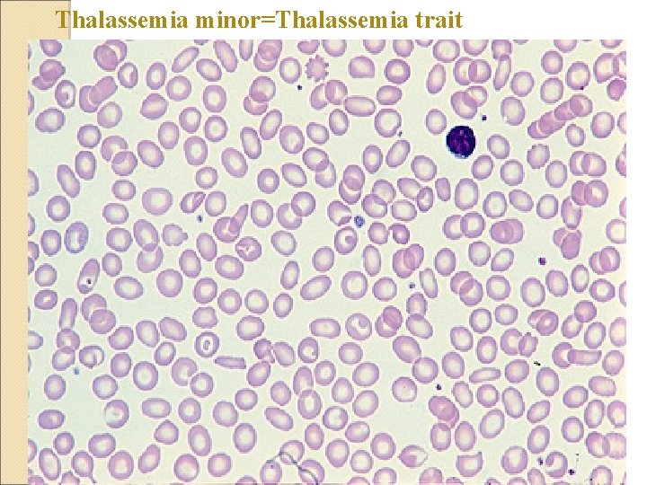 Thalassemia minor=Thalassemia trait 