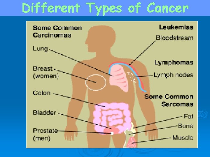 Different Types of Cancer 