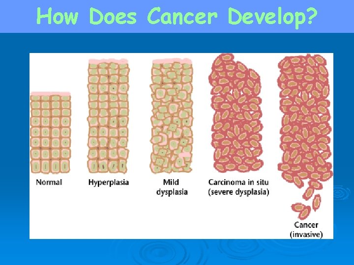 How Does Cancer Develop? abnormal growth loss of normal structure “in place” 