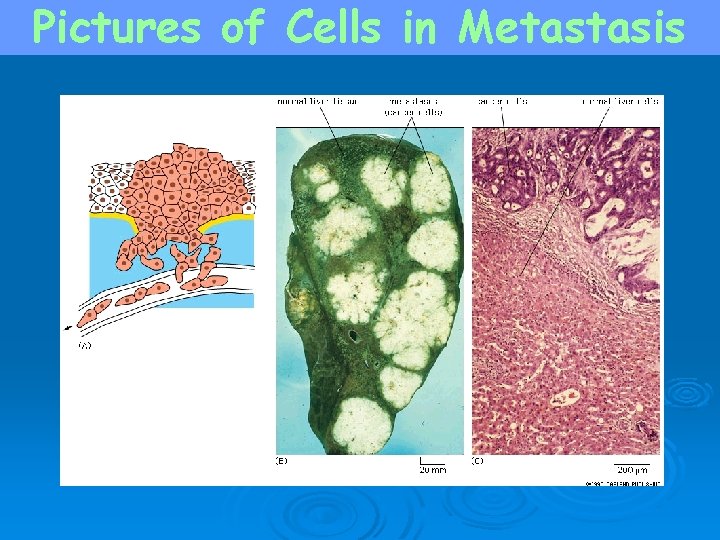 Pictures of Cells in Metastasis 