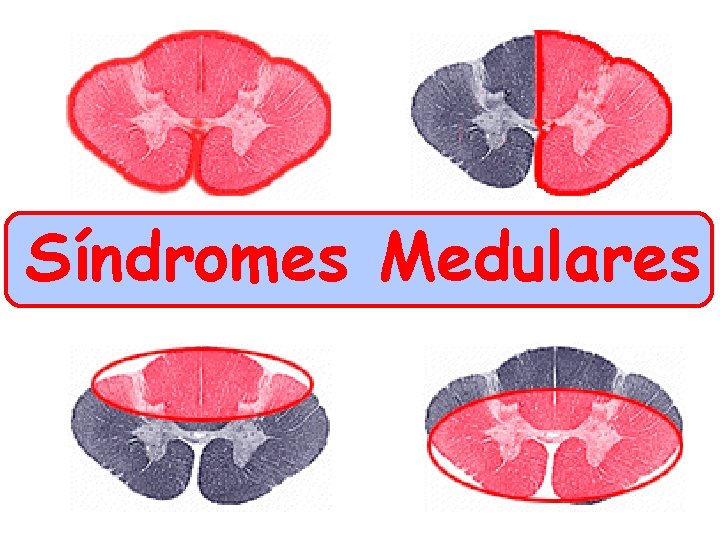 Síndromes Medulares 