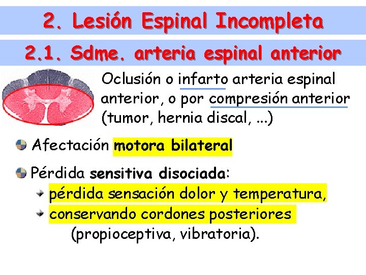2. Lesión Espinal Incompleta 2. 1. Sdme. arteria espinal anterior Oclusión o infarto arteria