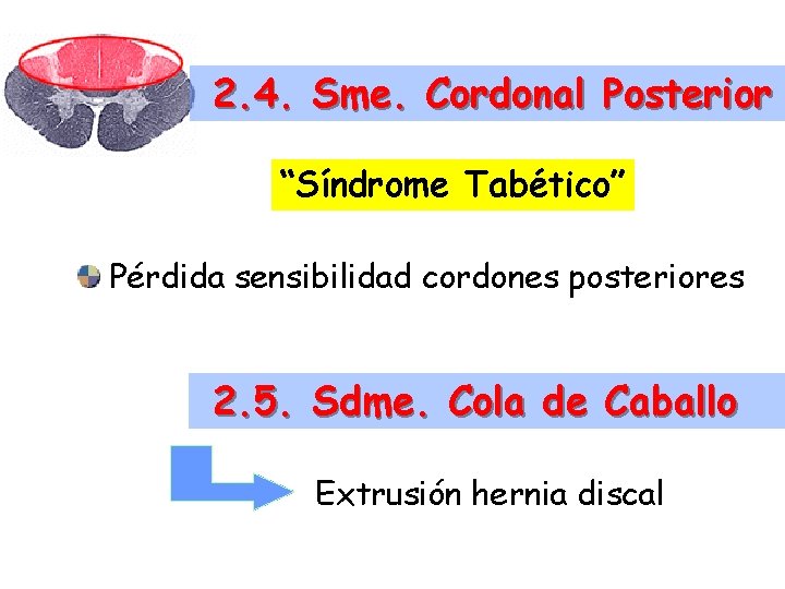 2. 4. Sme. Cordonal Posterior “Síndrome Tabético” Pérdida sensibilidad cordones posteriores 2. 5. Sdme.