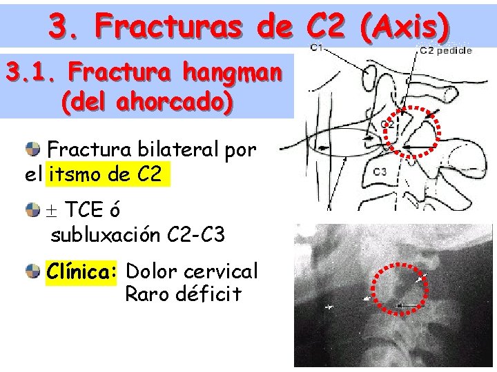 3. Fracturas de C 2 (Axis) 3. 1. Fractura hangman (del ahorcado) Fractura bilateral