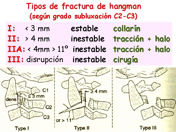 Tipos de fractura de hangman (según grado subluxación C 2 -C 3) I: <