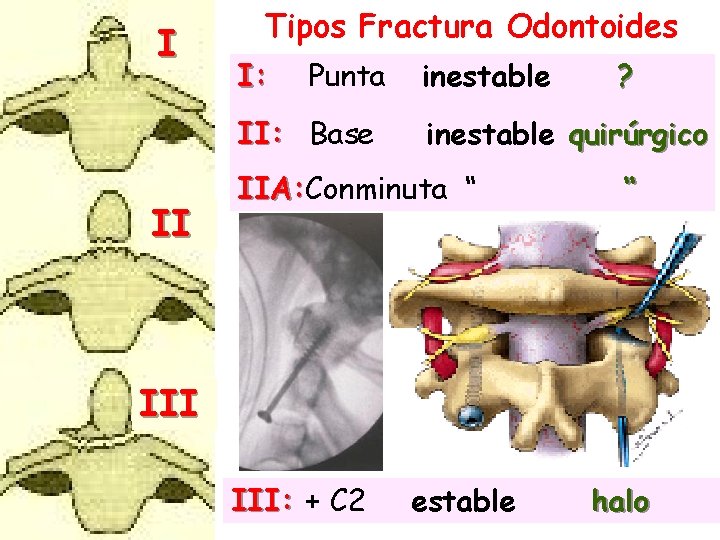 I Tipos Fractura Odontoides I: Punta II: Base II inestable ? inestable quirúrgico IIA: