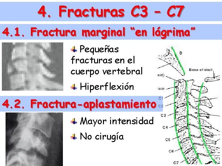 4. Fracturas C 3 – C 7 4. 1. Fractura marginal “en lágrima” Pequeñas