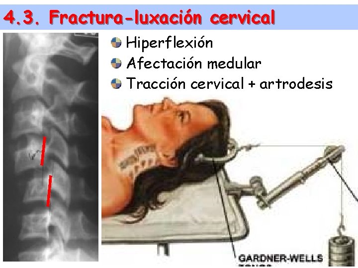 4. 3. Fractura-luxación cervical Hiperflexión Afectación medular Tracción cervical + artrodesis 