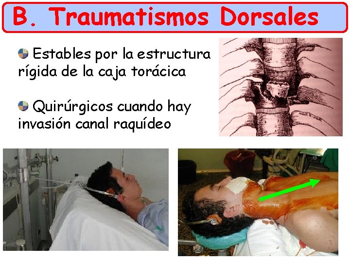 B. Traumatismos Dorsales Estables por la estructura rígida de la caja torácica Quirúrgicos cuando
