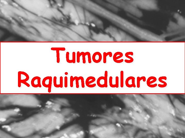 Tumores Raquimedulares 