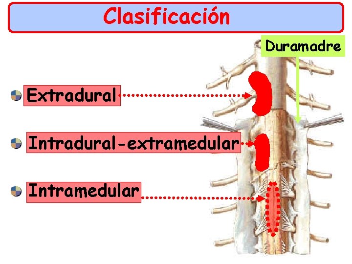 Clasificación Duramadre Extradural Intradural-extramedular Intramedular 