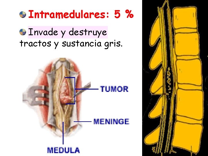 Intramedulares: 5 % Invade y destruye tractos y sustancia gris. 