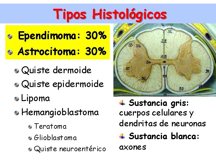 Tipos Histológicos Ependimoma: 30% Astrocitoma: 30% Quiste dermoide Quiste epidermoide Lipoma Hemangioblastoma Teratoma Glioblastoma