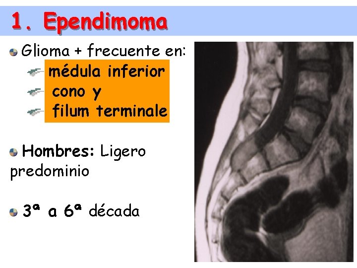 1. Ependimoma Glioma + frecuente en: médula inferior cono y filum terminale Hombres: Ligero