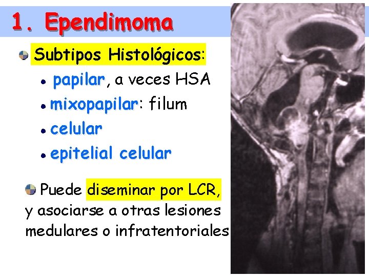 1. Ependimoma Subtipos Histológicos: papilar, papilar a veces HSA mixopapilar: mixopapilar filum celular epitelial