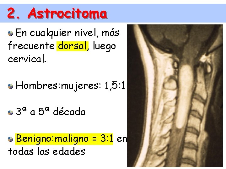 2. Astrocitoma En cualquier nivel, más frecuente dorsal, luego cervical. Hombres: mujeres: 1, 5: