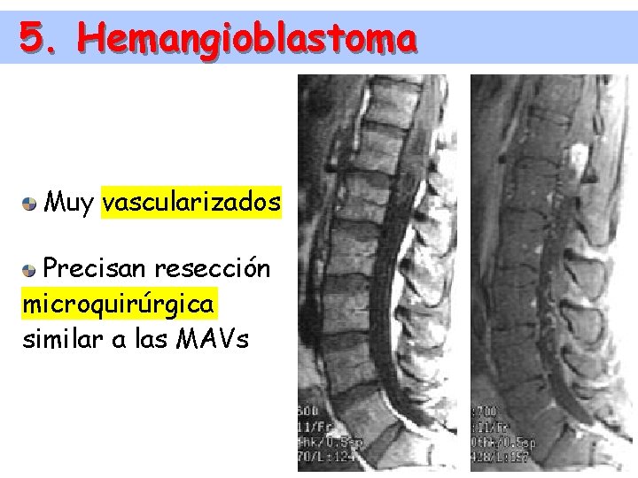 5. Hemangioblastoma Muy vascularizados Precisan resección microquirúrgica similar a las MAVs 