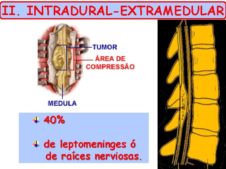 II. INTRADURAL-EXTRAMEDULAR 40% de leptomeninges ó de raíces nerviosas. 