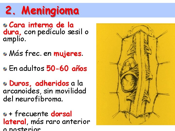 2. Meningioma Cara interna de la dura, con pedículo sesil o amplio. Más frec.
