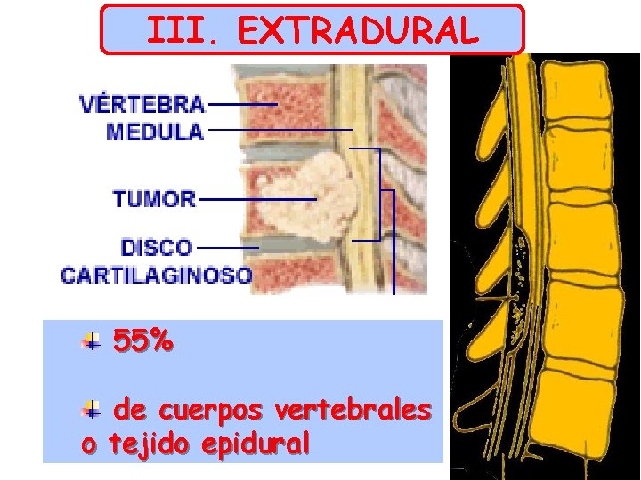 III. EXTRADURAL 55% de cuerpos vertebrales o tejido epidural 