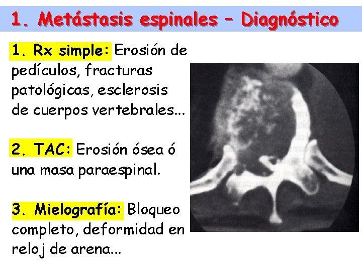 1. Metástasis espinales – Diagnóstico 1. Rx simple: Erosión de pedículos, fracturas patológicas, esclerosis