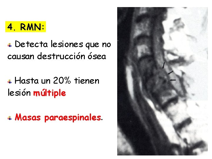 4. RMN: Detecta lesiones que no causan destrucción ósea Hasta un 20% tienen lesión