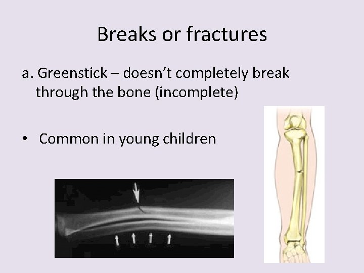 Breaks or fractures a. Greenstick – doesn’t completely break through the bone (incomplete) •