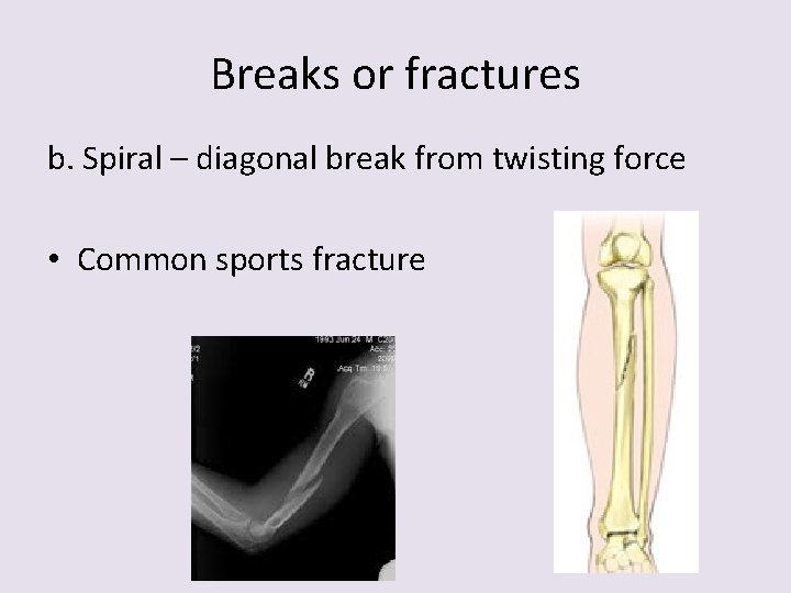 Breaks or fractures b. Spiral – diagonal break from twisting force • Common sports