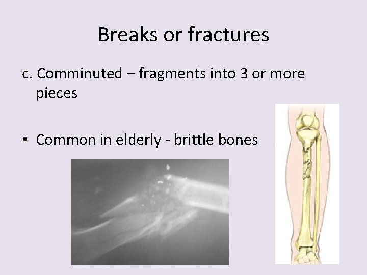 Breaks or fractures c. Comminuted – fragments into 3 or more pieces • Common