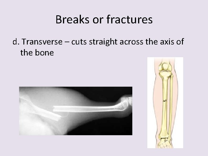 Breaks or fractures d. Transverse – cuts straight across the axis of the bone