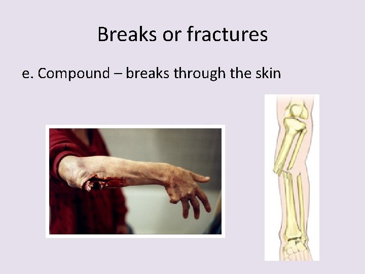 Breaks or fractures e. Compound – breaks through the skin 