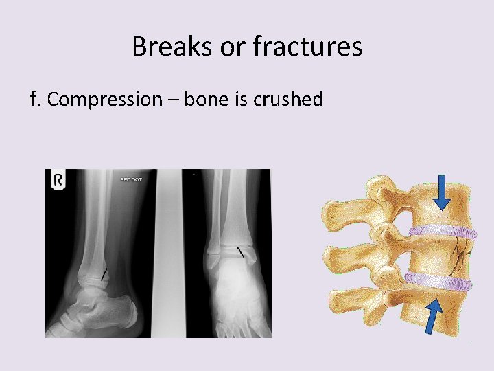 Breaks or fractures f. Compression – bone is crushed 