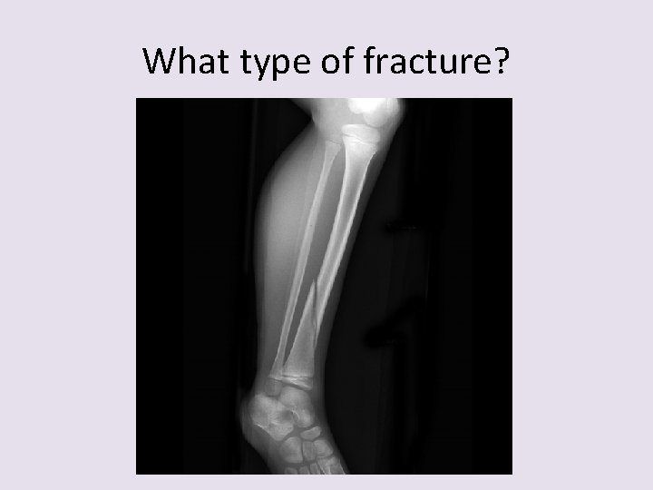 What type of fracture? 