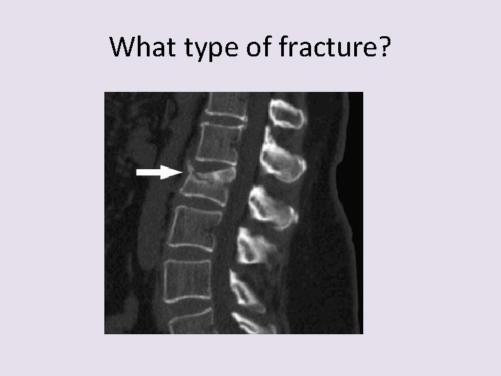 What type of fracture? 