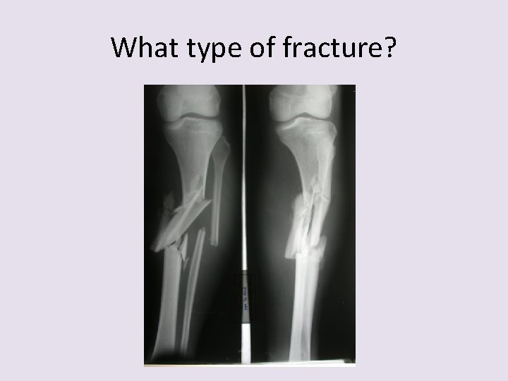 What type of fracture? 