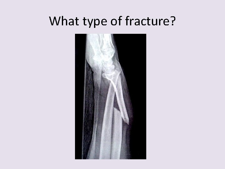 What type of fracture? 